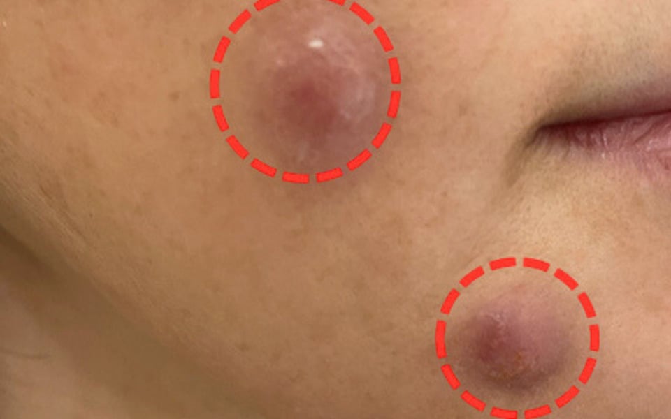 tác dụng phụ của căng chỉ