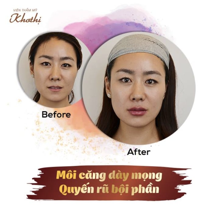 Sự thay đổi ngoạn mục khi tạo hình dáng môi mỉm cười đầy đặn, căng mọng đầy sức sống của khách hàng tại Khơ Thị