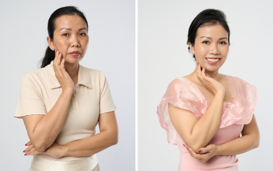 thẩm mỹ nội khoa thermage