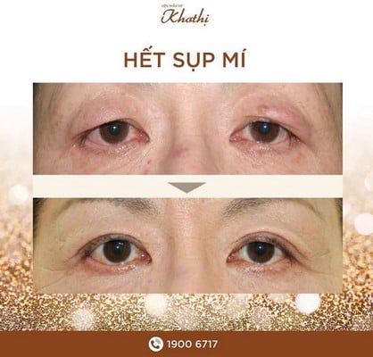 Hết sụp mí mắt