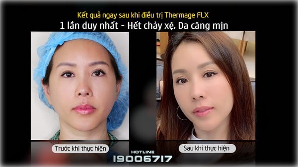Thermage FLX là bí quyết giúp Hoa hậu Thu Hoài luôn trẻ trung dù bước qua độ tuổi tứ tuần.