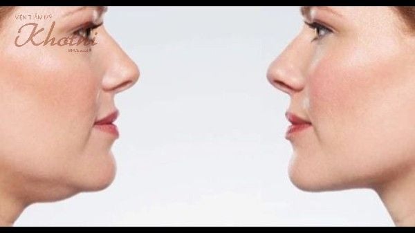 Đá lạnh giúp giảm mỡ cằm, má hiệu quả