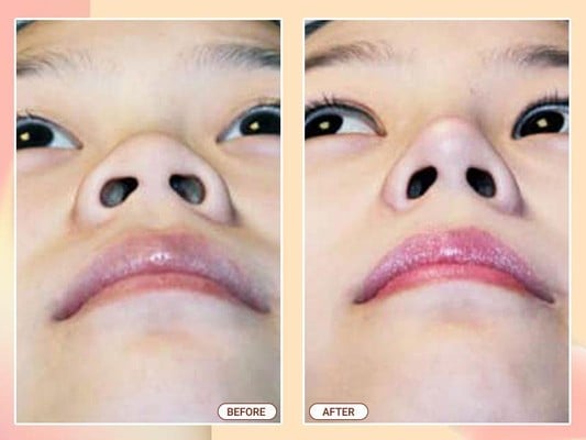 Phẫu thuật thu gọn cánh mũi Phẫu thuật thu gọn cánh mũi