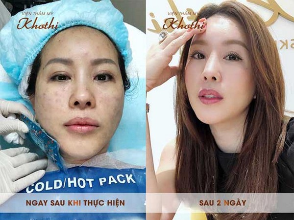 Hoa hậu Thu Hoài sau khi thực hiện tiêm thủy quang Diamond.