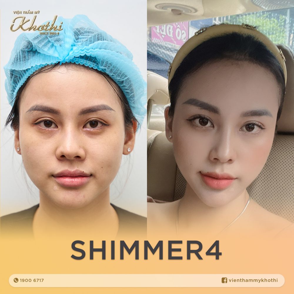 tiêm 4 điểm