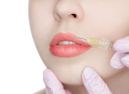 Tiêm filler làm đầy môi gợi cảm, không phẫu thuật Tiêm filler làm đầy môi gợi cảm, không phẫu thuật