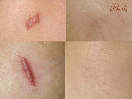 Xóa sẹo lồi nhanh, an toàn, hiệu quả với phương pháp tiêm trị sẹo lồi tại khơ thị Xóa sẹo lồi nhanh, an toàn, hiệu quả với phương pháp tiêm trị sẹo lồi tại khơ thị