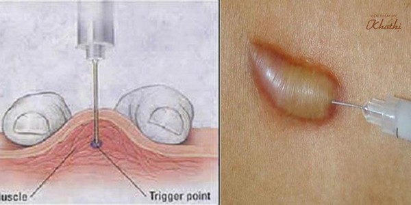 Tiêm trị sẹo lồi hoàn toàn an toàn Tiêm trị sẹo lồi hoàn toàn an toàn
