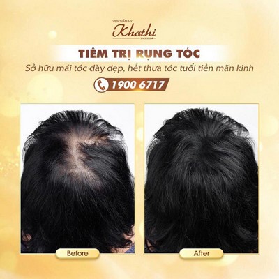 Tiêm trị rụng tóc Hair Activ hiệu quả Tiêm trị rụng tóc Hair Activ hiệu quả
