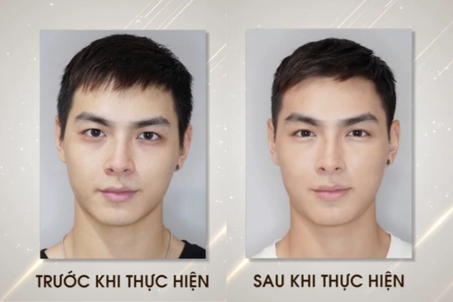 Tiêm tan quầng thâm mắt Khơ