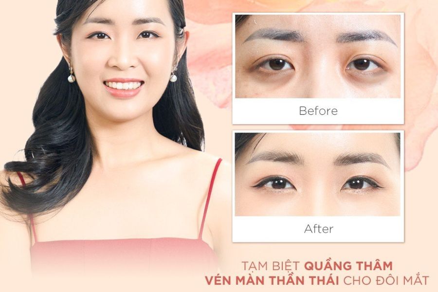 Tiêm tan quầng thâm mắt Khơ