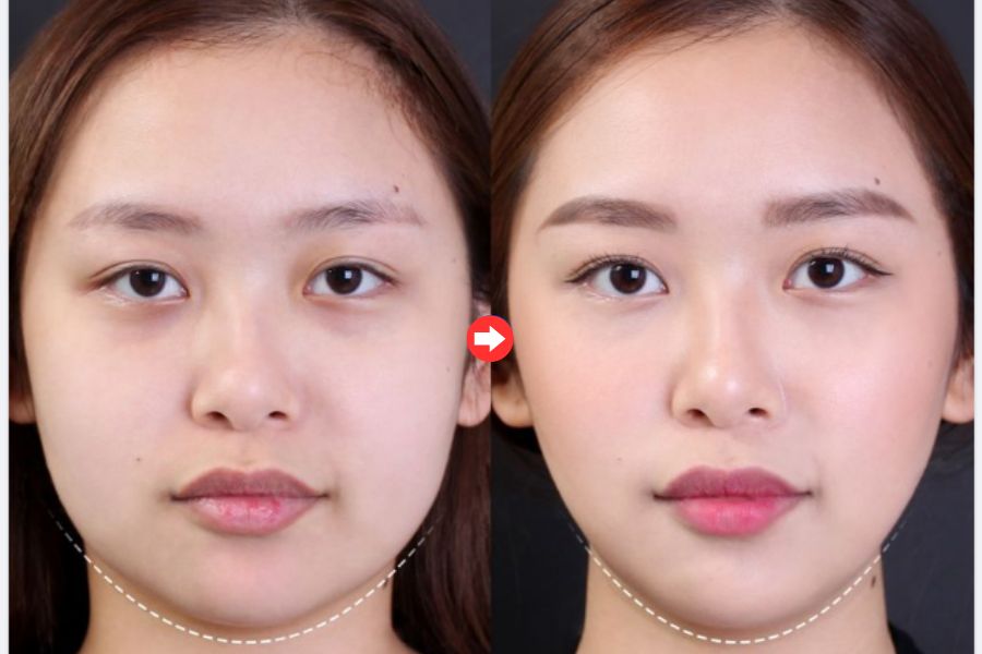 Tiêm thon gọn Khơ Thị giúp cải thiện vẻ ngoài tự nhiên và tăng thêm sự tự tin cho bạn.