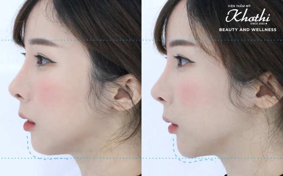 tiêm filler cằm