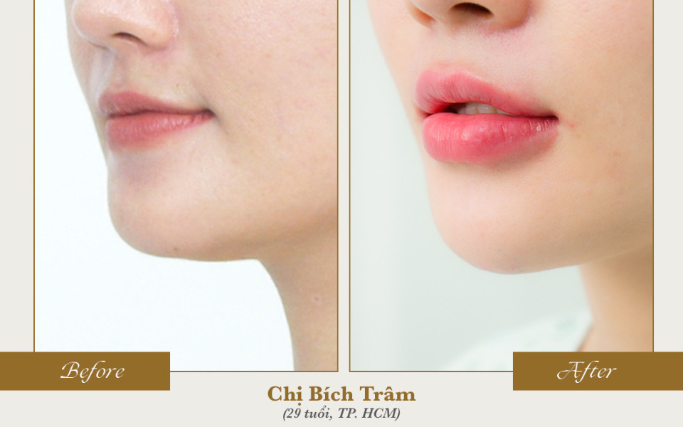 tiêm filler môi khơ thị