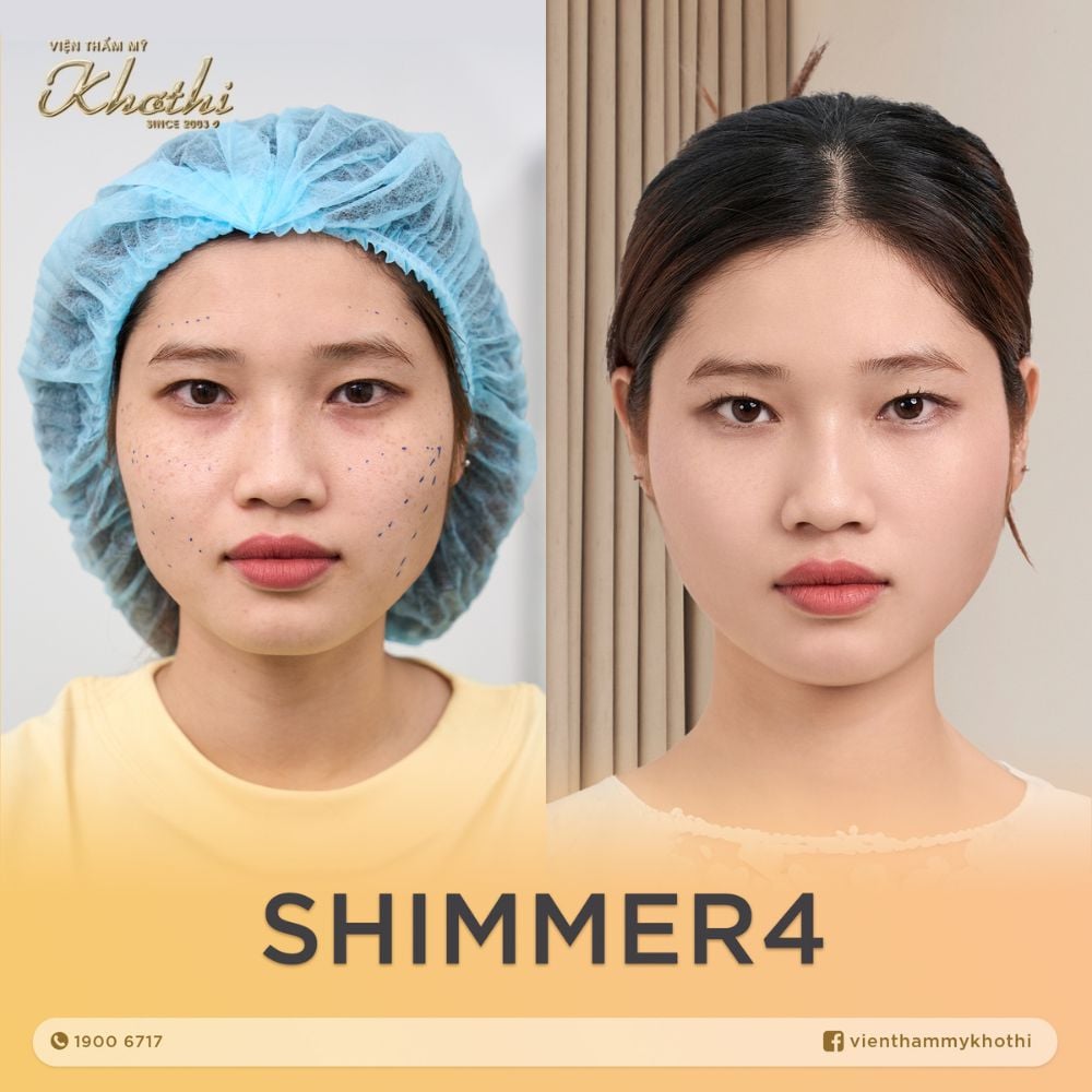 kỹ thuật tiêm 4 điểm