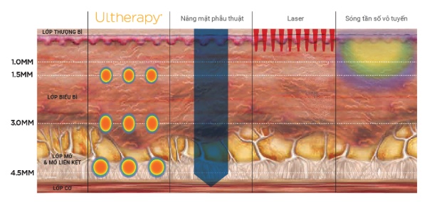 Công nghệ nâng cơ Ultherapy hiện đang đi đầu về hiệu quả nâng cơ, làm thon gọn mặt tự nhiên