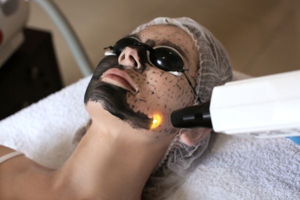 Dùng tia laser làm sạch lớp than hoạt tính