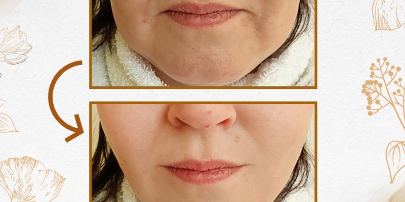 Công nghệ Thermage FLX giúp trẻ hóa da và săn chắc cơ mặt hiệu quả