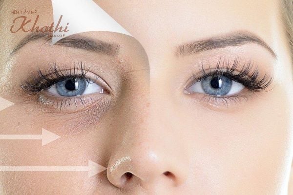 Chất làm đầy giúp làm căng và trẻ hóa da vùng mắt