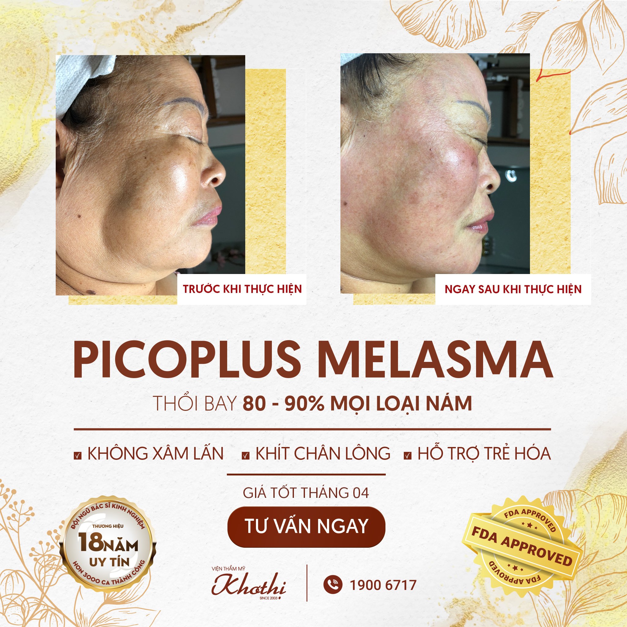 Trị nám triệt để với Picoplus Melasma - Công nghệ #1 thế giới