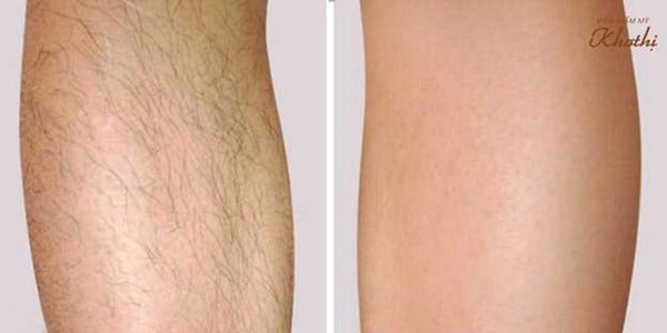 Triệt lông chân cho thân láng mịn, sạch sẽ Triệt lông chân cho thân láng mịn, sạch sẽ