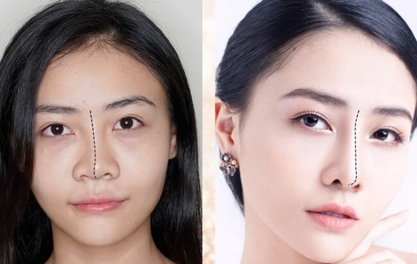 Lương Ngọc Ánh trước và sau khi sửa mũi hỏng tại Khơ Thị