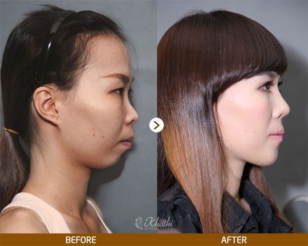Trước và sau khi thẩm mỹ tại Khơ Thị