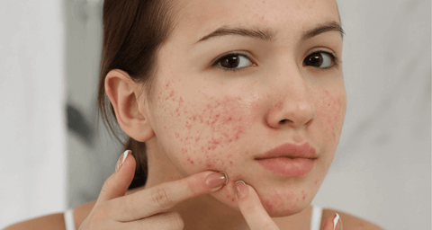 Uống whey có nổi mụn không? Nguyên nhân và cách khắc phục hiệu quả