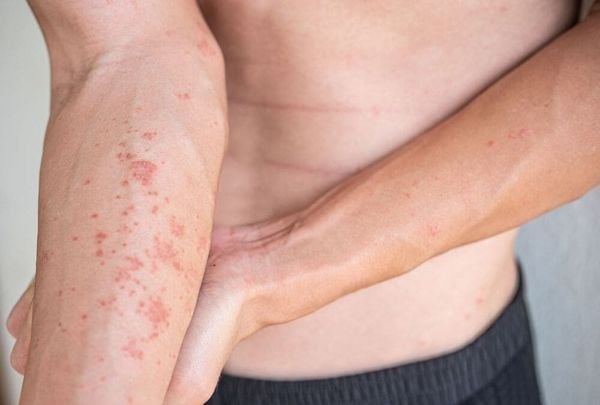 Tinh dầu hoa anh thảo làm dịu da hiệu quả cho người bị viêm da