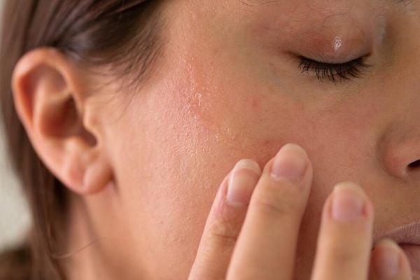 Khô da là dấu hiệu thường thấy khi cơ thể thiếu axit béo