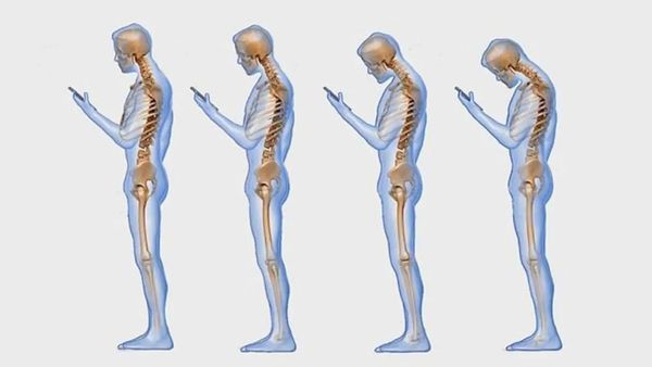 Gù lưng có thể bắt nguồn từ nhiều nguyên nhân khác nhau