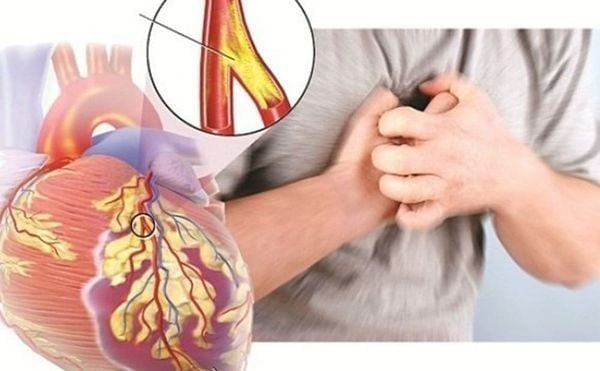 Omega 3 hỗ trợ điều trị bệnh động mạch vành