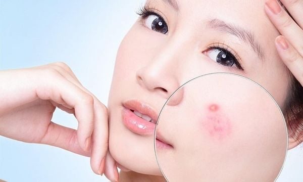Một số người có thể nổi mụn khi uống collagen