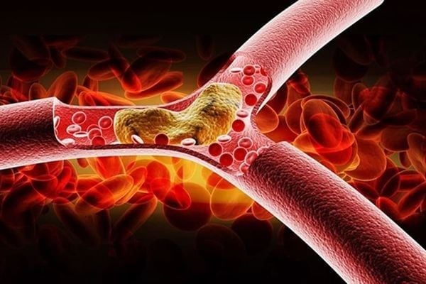 Omega-3 giúp loại bỏ triglyceride khỏi máu