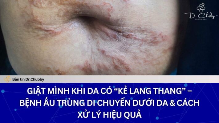 Ấu Trùng Di Chuyển Dưới Da: Nguyên Nhân, Dấu Hiệu & Cách Điều Trị