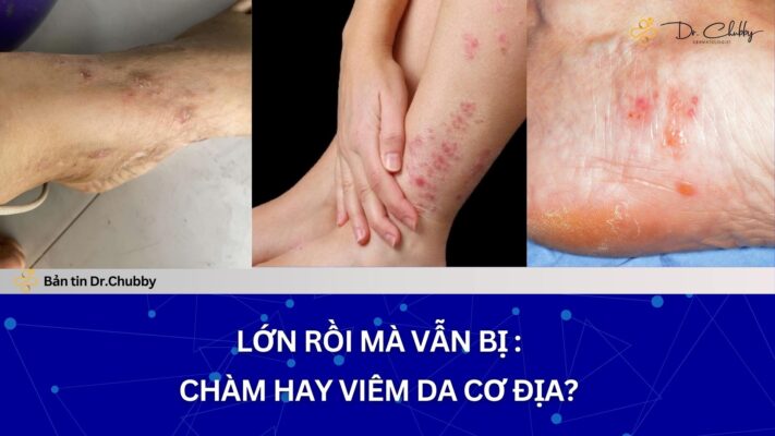 Chàm, Viêm Da Cơ Địa Ở Chân: Vì Sao Mãi Không Khỏi?