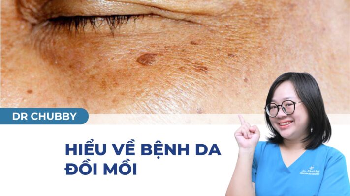 Da Đồi Mồi: Nguyên Nhân, Cách Xử Lý & Phòng Ngừa Hiệu Quả