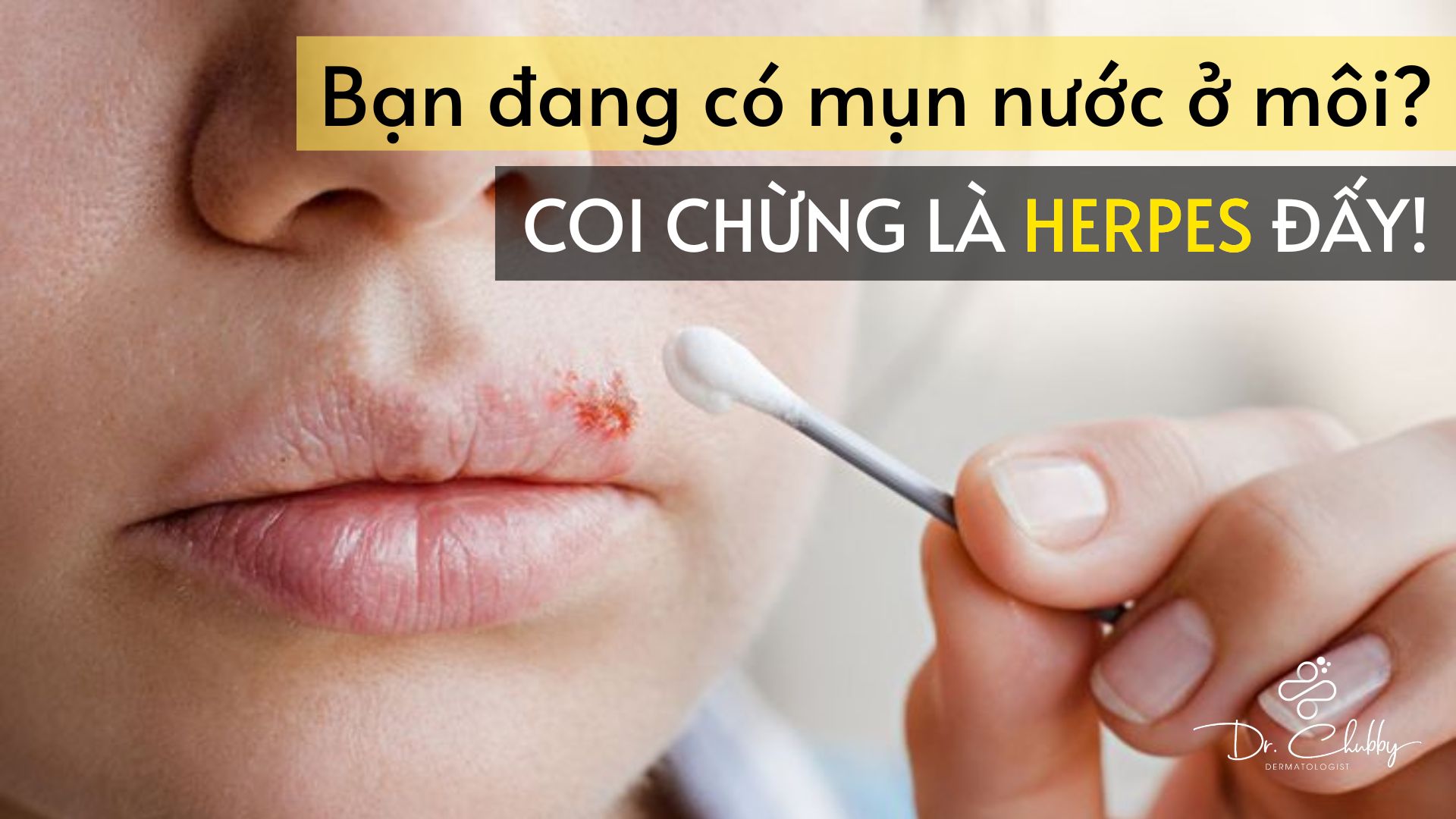 Mụn Nước Ở Môi Là Herpes? Cách Nhận Biết Và Điều Trị Hiệu Quả