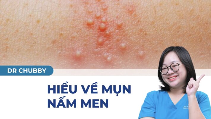 Mụn Nấm Men: Cách Nhận Biết, Điều Trị Hiệu Quả & Phòng Ngừa