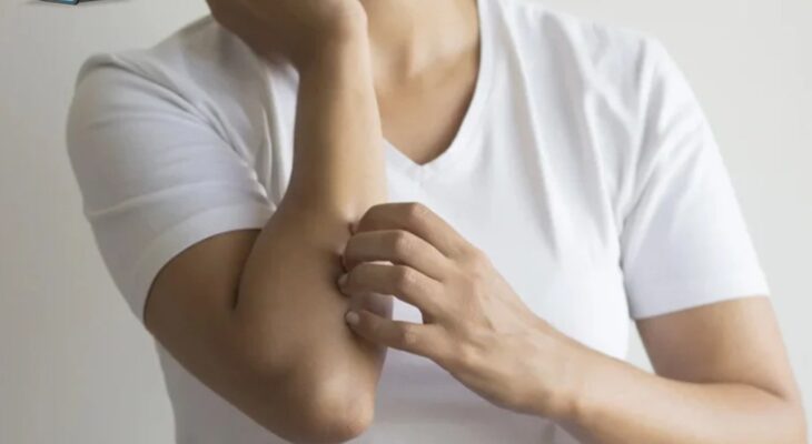 Lichen phẳng và những điều bạn cần biết