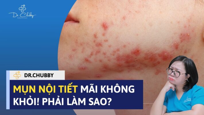 Mụn Nội Tiết Mãi Không Dứt? Nguyên Nhân, Cách Trị Hiệu Quả