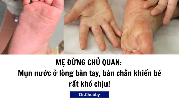 Mụn Nước Ở Lòng Bàn Tay, Chân Của Bé – Dấu Hiệu Chàm Tổ Đỉa?
