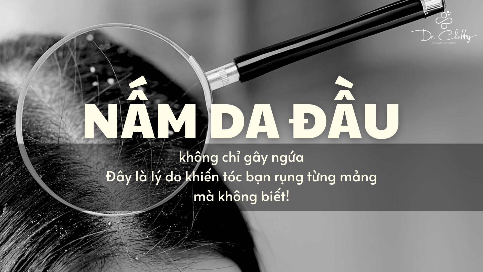 Đừng chủ quan khi tóc con rụng thành mảng - Có thể là nấm!