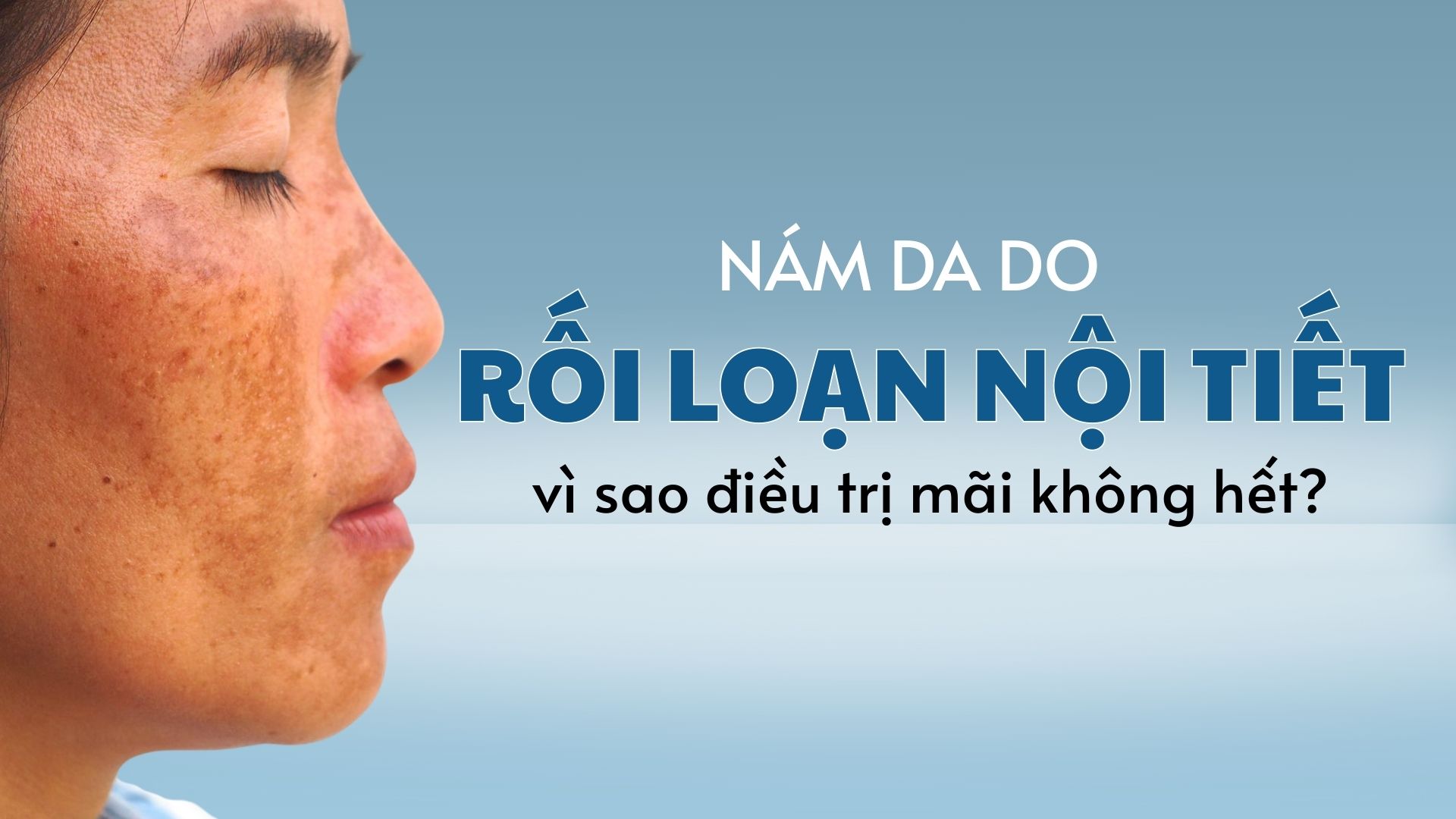 Nám Da Do Rối Loạn Nội Tiết: Vì Sao Điều Trị Mãi Không Hết?