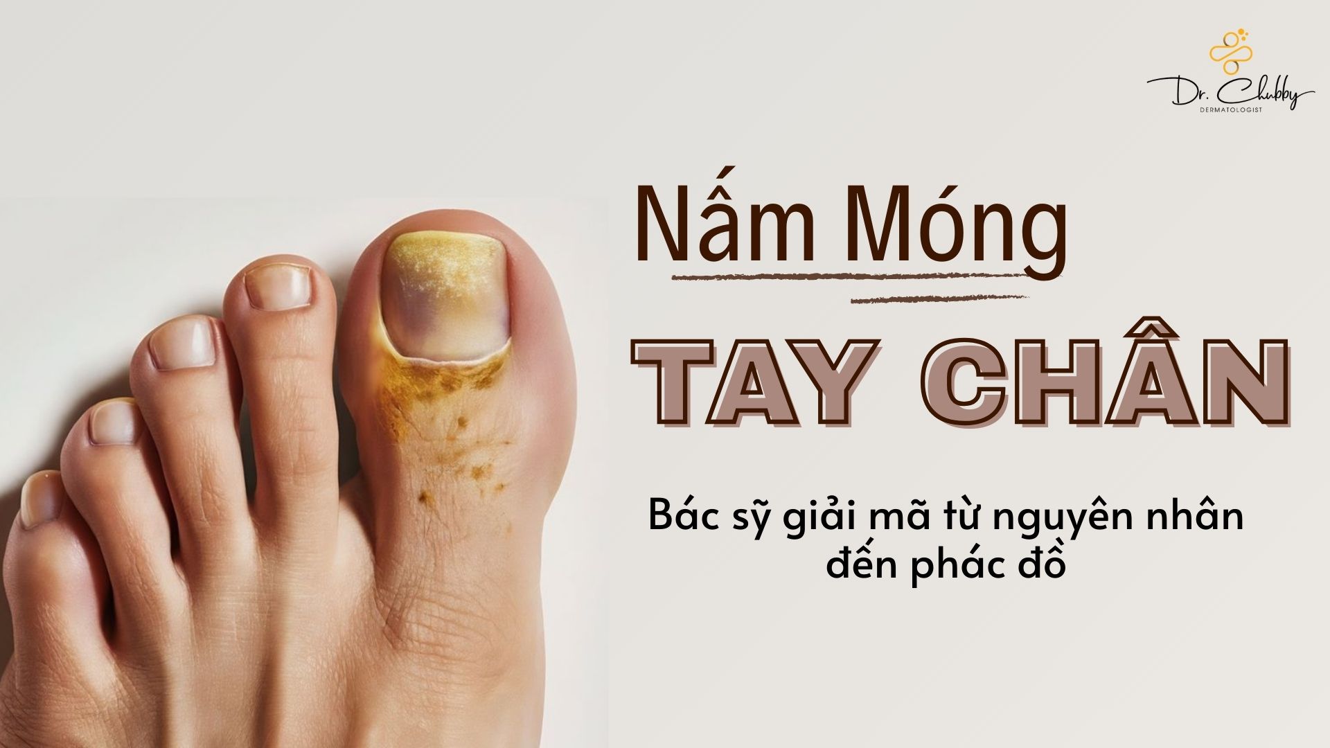 Nấm Móng Tay, Móng Chân: Nguyên Nhân, Dấu Hiệu Và Cách Điều Trị Hiệu Quả