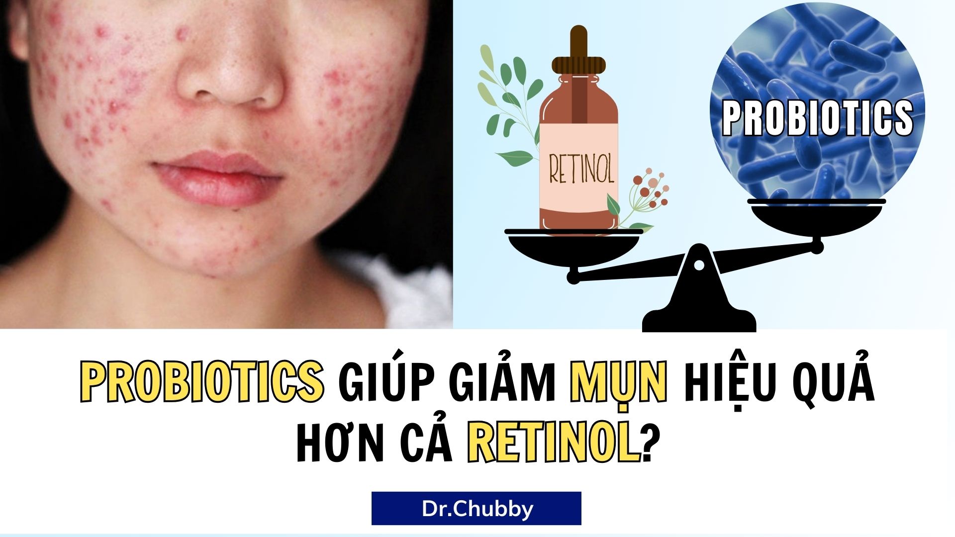 Probiotics Trị Mụn: Hiệu Quả Hơn Retinol? Sự Thật Bất Ngờ!