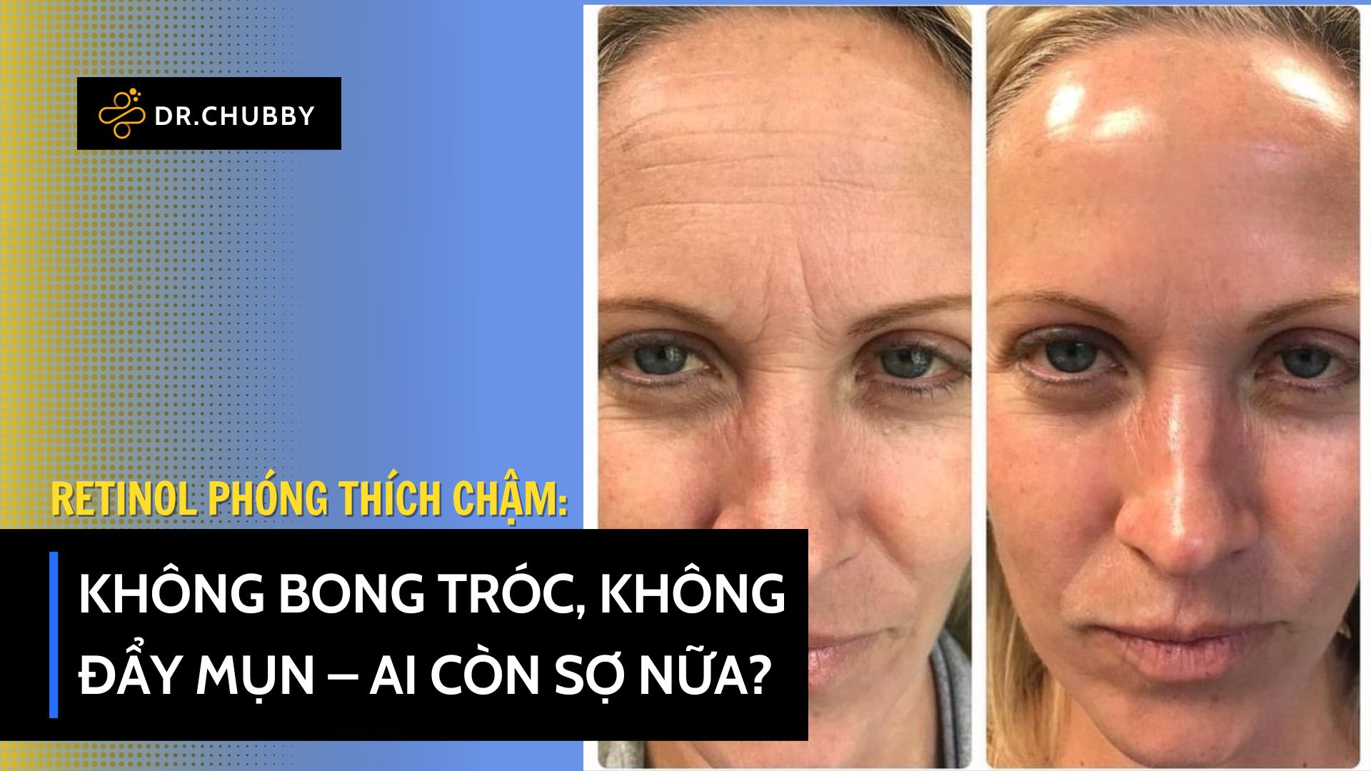 Retinol Thế Hệ Mới: Giảm Kích Ứng, Không Đẩy Mụn, Không Bong Tróc