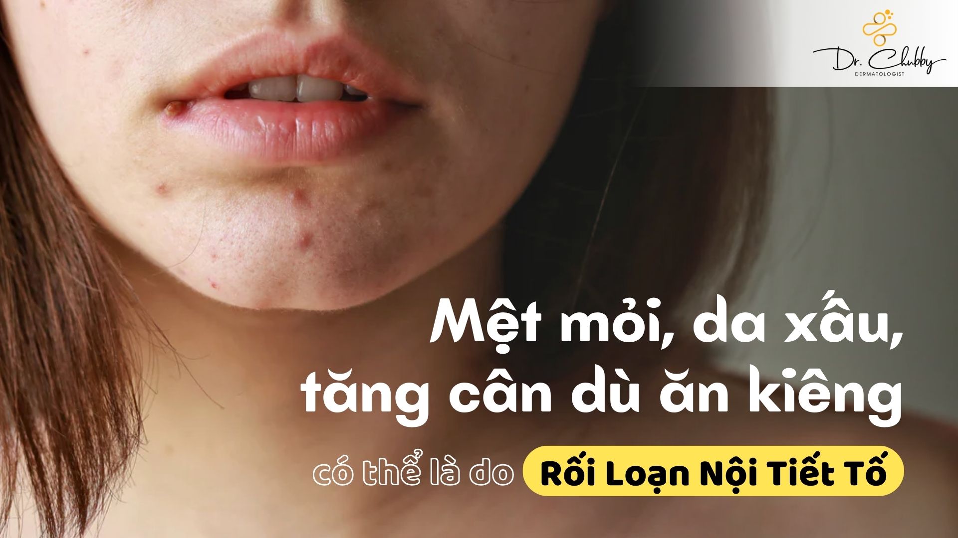 Rối Loạn Nội Tiết Tố: Nguyên Nhân Khiến Bạn Mệt Mỏi, Da Xấu, Tăng Cân