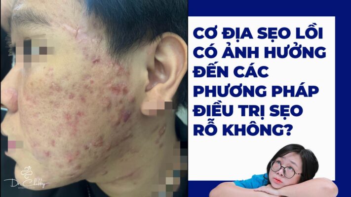 Cơ Địa Sẹo Lồi Có Trị Sẹo Rỗ Được Không? Chuyên Gia Giải Đáp