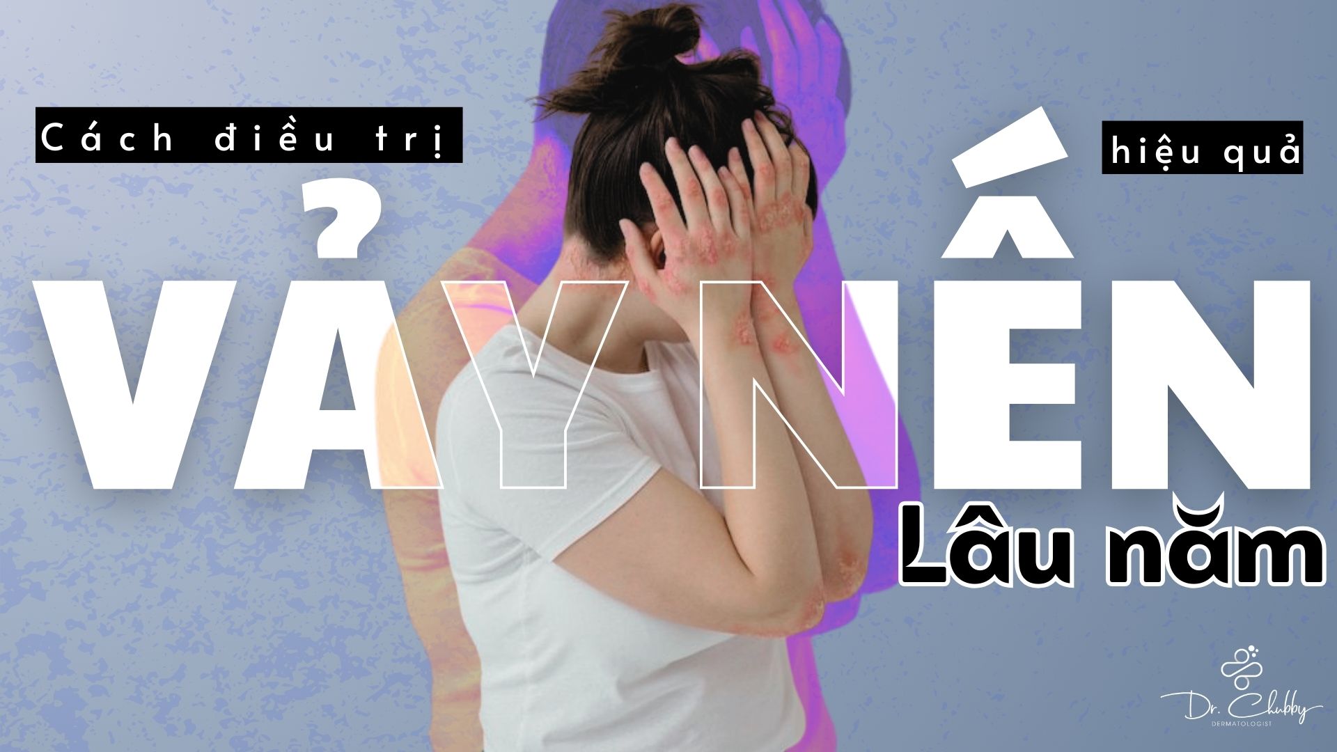 Vảy Nến Lâu Năm: Cách Điều Trị Hiệu Quả Không Dùng Mỗi Corticoid